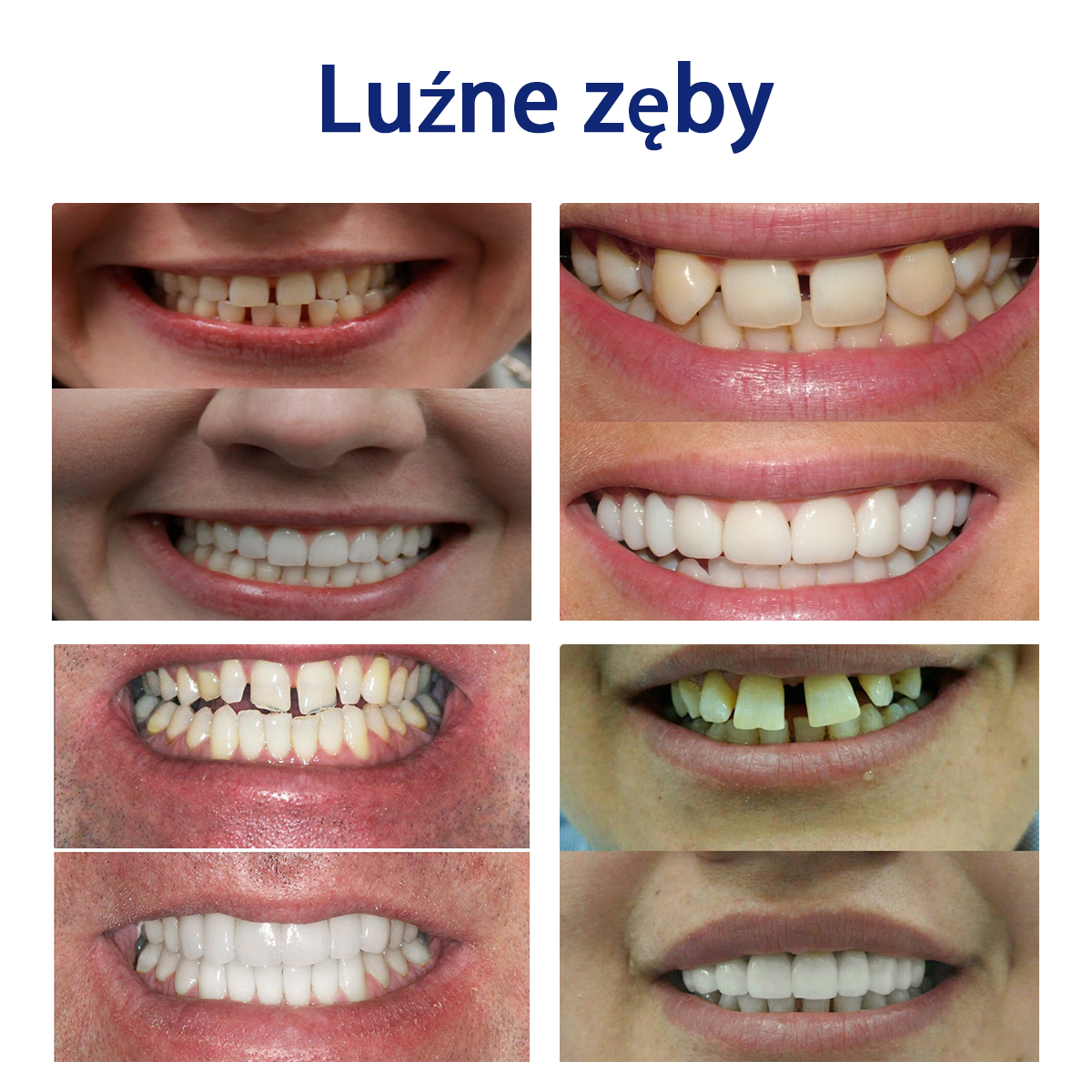 Bikenda™ Silikonowy Zestaw Do Mierzenia Protez 🧨🧨 (👩🔬 Zgodny z CED, zatwierdzony przez profesjonalnych dentystów)