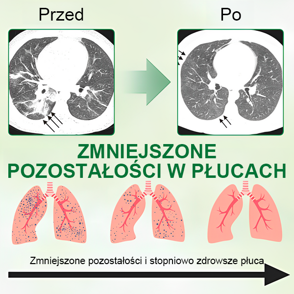 [Oficjalny flagowy sklep marki]👨‍⚕️MIQIKO Zaawansowany spray oczyszczający płuca (☘️zalecany przez specjalistów od płuc☘️)